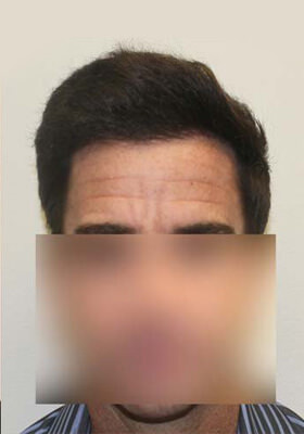 Hair Transplant Before After Photos - One Procedures