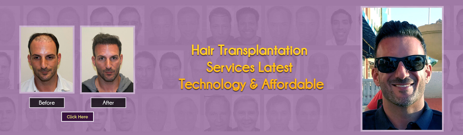 best hair replacement method