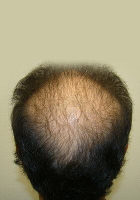 hair transplant before after Photos