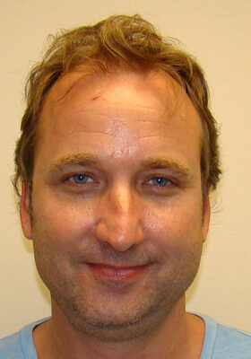 hair transplant photos