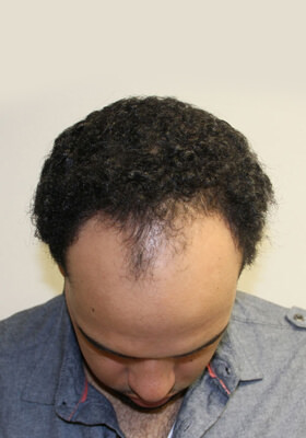 hair transplant before after Photos