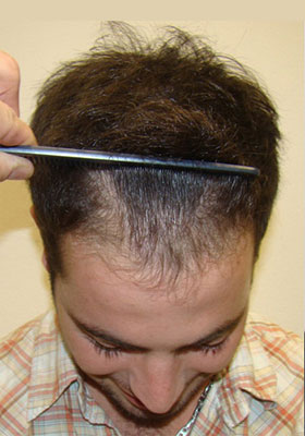 hair transplant before after Photos