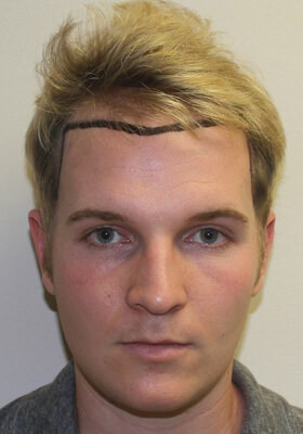 hair transplant photos