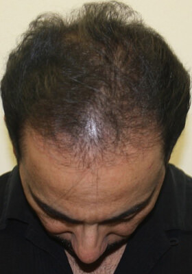 hair transplant photos