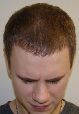 hair transplant photos