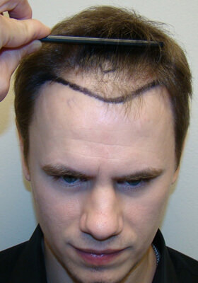 hair transplant photos