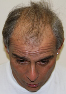 hair transplant photos