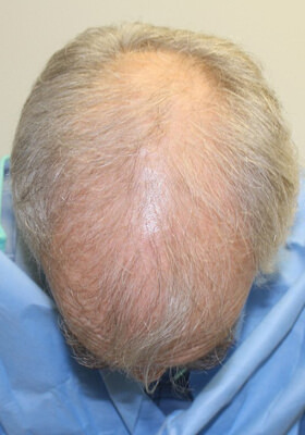 hair transplant before after Photos