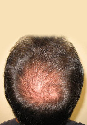 hair transplant photos