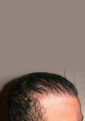 hair transplant before after Photos