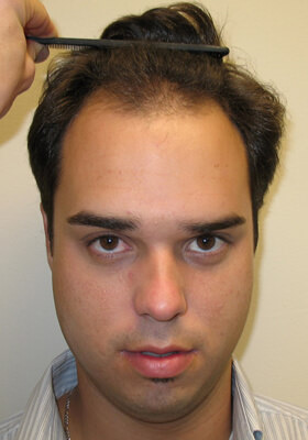 hair transplant before after Photos