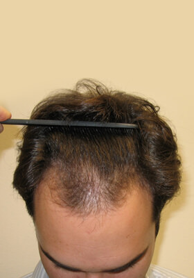 hair transplant photos