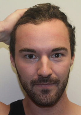 hair transplant photos