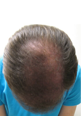 hair transplant before after Photos