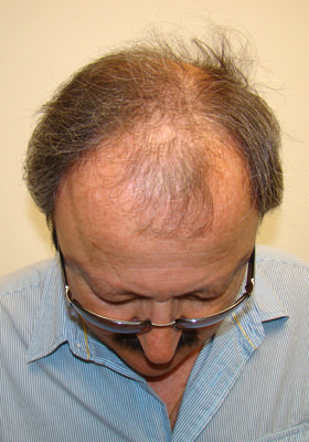 hair transplant before after Photos