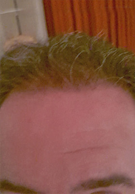 hair transplant photos