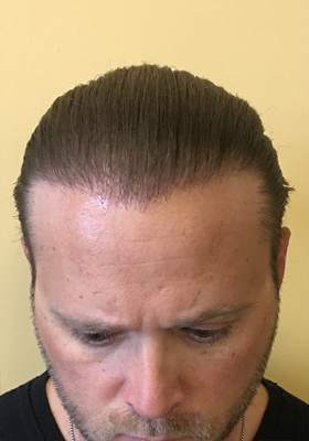 hair transplant photos