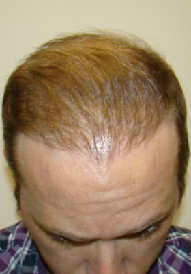 hair transplant photos