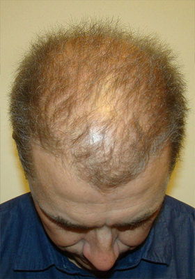 hair transplant before after Photos