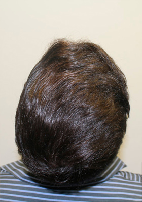 hair transplant before after Photos