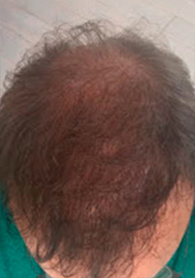 hair transplant before after Photos