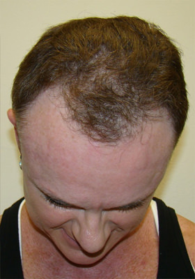 hair transplant photos