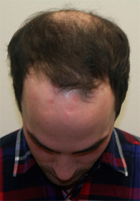 hair transplant photos