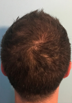 hair transplant before after Photos