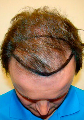 hair transplant photos