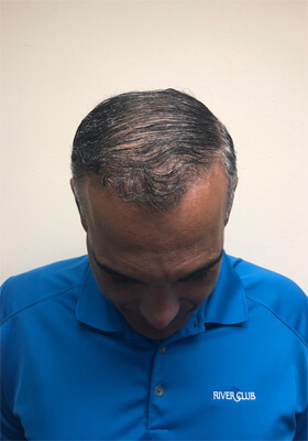 hair transplant before after Photos