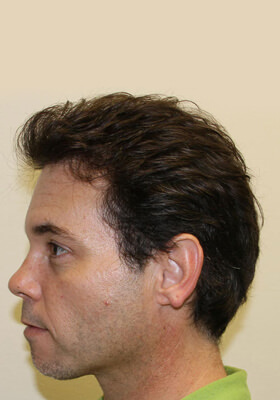 hair transplant before after Photos