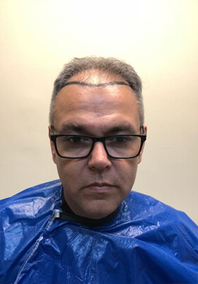 hair transplant before after Photos