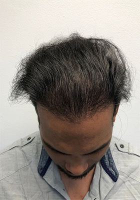 hair transplant photos