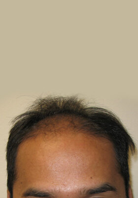 hair transplant before after Photos