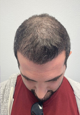 hair transplant before after Photos