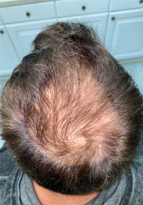 hair transplant before after Photos