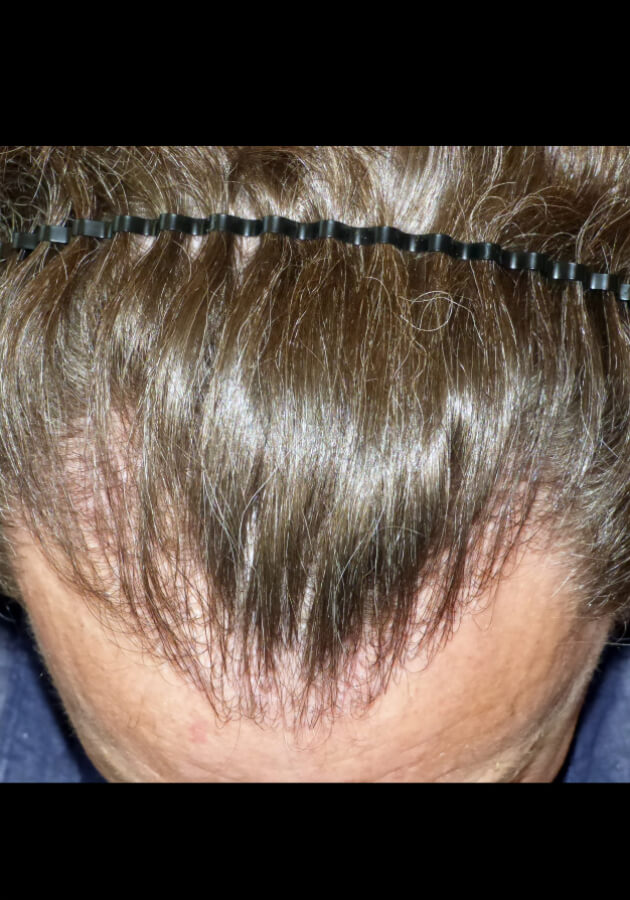 hair transplant photos