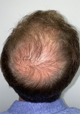 hair transplant before after Photos