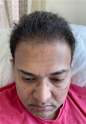 hair transplant before after Photos