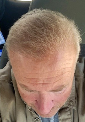 hair transplant before after Photos