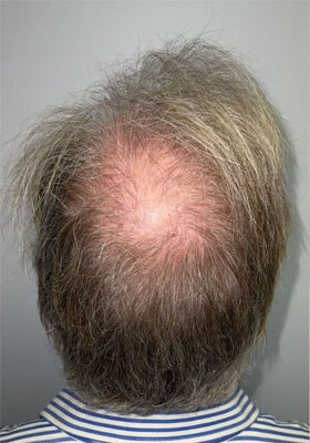 hair transplant before after Photos