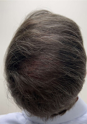 hair transplant before after Photos