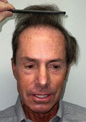 hair transplant before after Photos