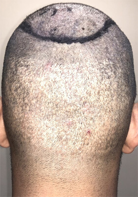 hair transplant before after Photos