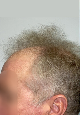 hair transplant before after Photos