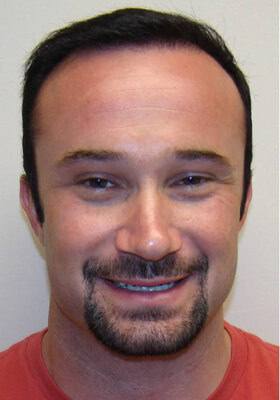 hair transplant before after Photos