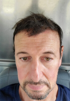 hair transplant photos