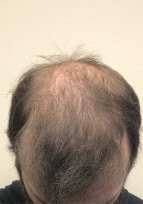 hair transplant before after Photos