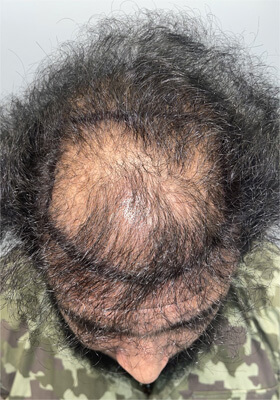 hair transplant before after Photos