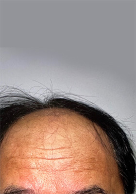 hair transplant photos